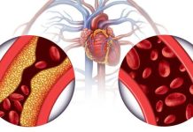 Yuk Simak Pola Hidup Sehat Cegah Terkena Kolestrol Tinggi